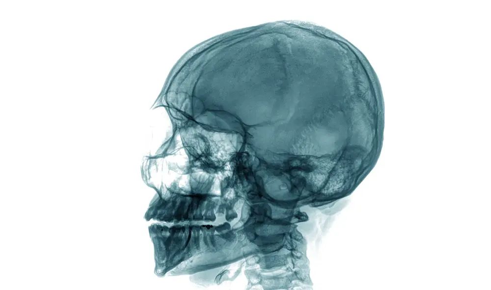 Visión en rayos X de un cráneo humano. Foto: referencial/Adobe Stock