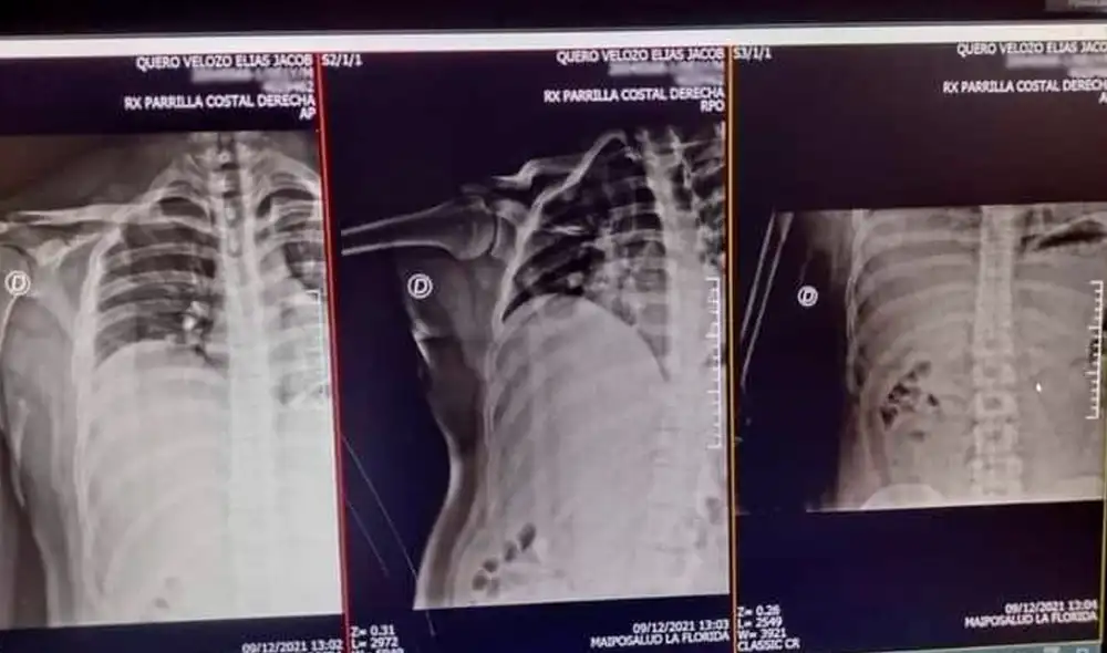 Radiografía difundida del joven Elías Quero tras denunciar los ataques que recibió mientras estuvo detenido. Foto: Andrés Figueroa Cornejo/Twitter