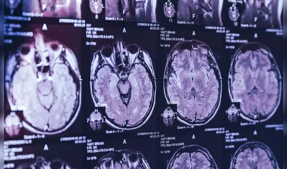 La enfermedad es degenerativa y causa alucinaciones. Foto: The Guardian