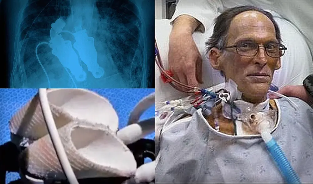 El paciente Craig Lewis había sido sometido a un ensayo de corazón artificial tras sufrir una infección cardiaca. Foto: Cinco Noticias / El corazón deja de latir El paciente Craig Lewis había sido sometido a un ensayo de corazón artificial tras sufrir una infección cardiaca. Foto: Cinco Noticias / El corazón deja de latir