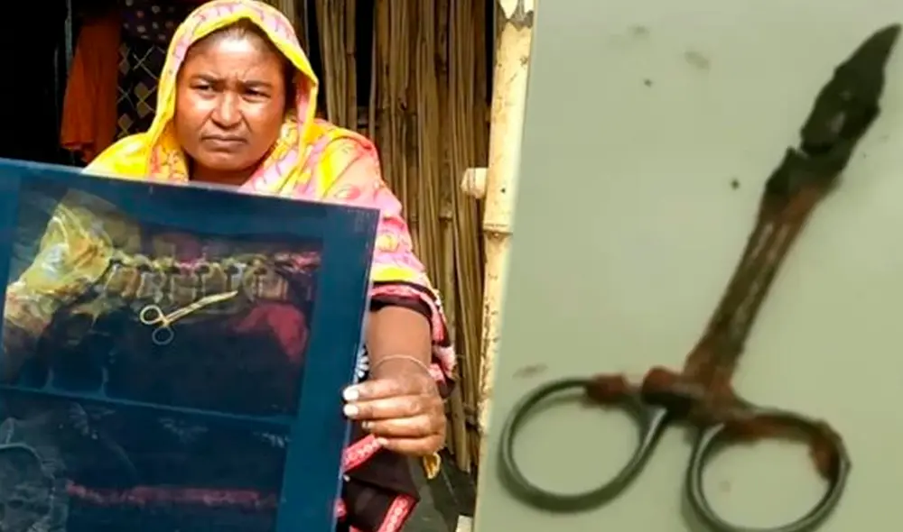 Tijera extraída a Bachena Khatun en Bangladesh. Foto: composición/SundarBon24-Independent