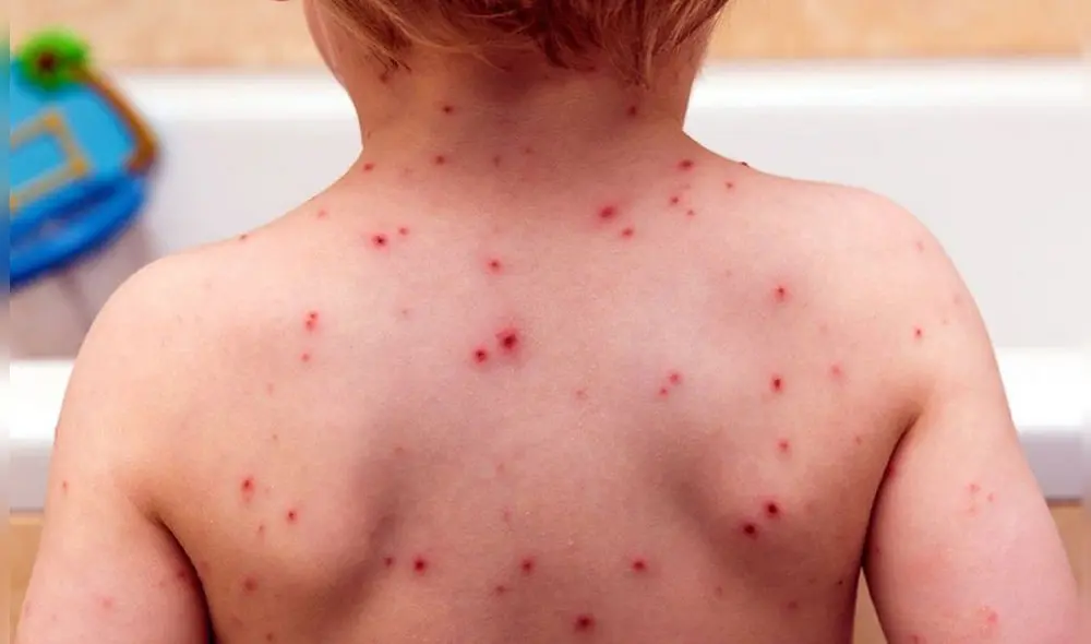 La varicela se da con mayor frecuencia en menores. No obstante, las personas adultas no están exentas a contraer la infección. Foto: El imparcial