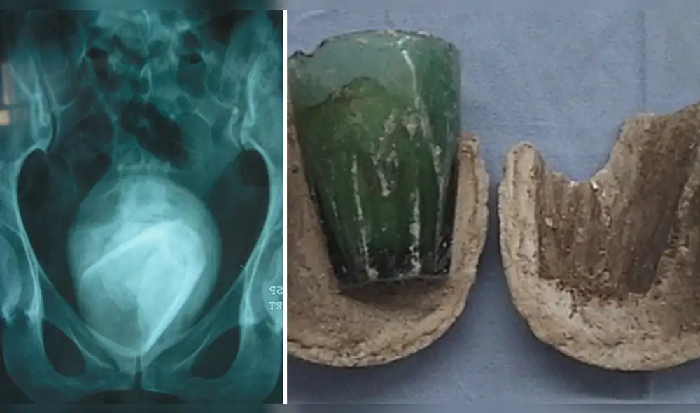 Imagen del objeto alojado dentro de la vejiga de la paciente. Foto: composición/ScienceDirect