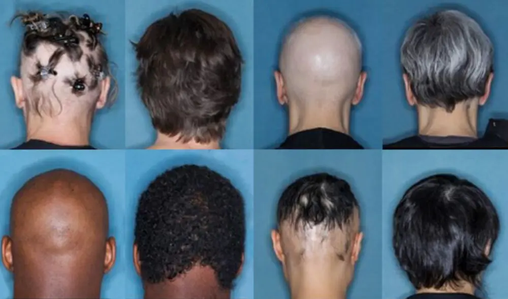 El fármaco barcitinib, consumido en dosis de 4 mg. durante 36 semanas, demostró revertir la caída del cabello, pero con algunos efectos secundarios. Foto: Universidad de Yale.