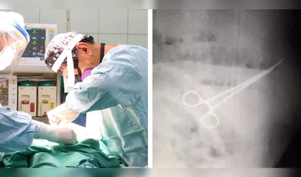 Le practicaron un examen de rayos X y revelaron que el hombre tenía unas tijeras en el estómago. Foto: Gore/Noticia al Día Le practicaron un examen de rayos X y revelaron que el hombre tenía unas tijeras en el estómago. Foto: Gore/Noticia al Día