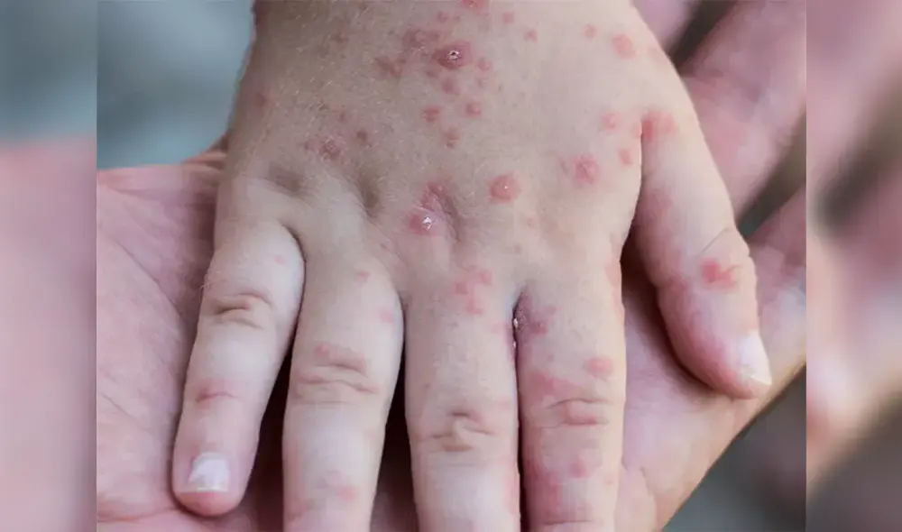 Cuatro regiones en alerta epidemiológica por brotes del virus coxsackie. Foto: Instagram / Vital Health Cuatro regiones en alerta epidemiológica por brotes del virus coxsackie. Foto: Instagram / Vital Health