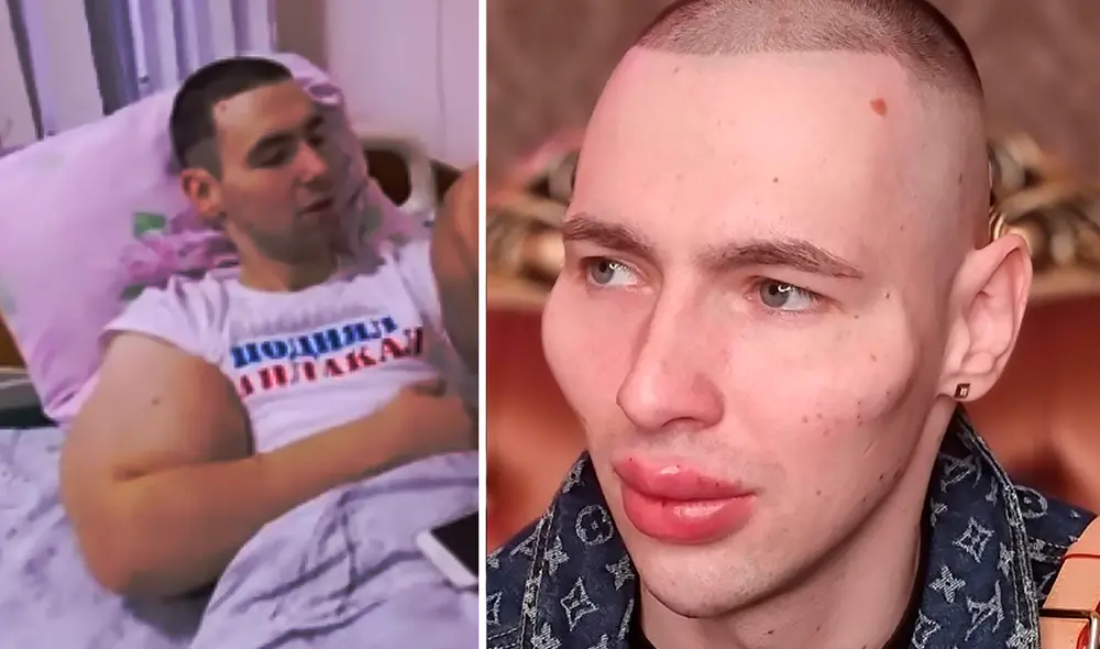 A pesar de las advertencias, el 'Popeye ruso' se operó el rostro para verse como un "extraterrestre". Foto: Kirill Tereshin