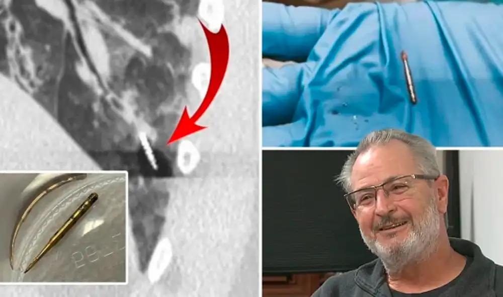 “Nunca fui tan feliz como cuando abrí los ojos y lo vi con una sonrisa bajo esa máscara agitando un pequeño recipiente de plástico con la herramienta”, expresó el paciente. Foto: Broncoscopia robótica por AB. Alraiyes / WALA “Nunca fui tan feliz como cuando abrí los ojos y lo vi con una sonrisa bajo esa máscara agitando un pequeño recipiente de plástico con la herramienta”, expresó el paciente. Foto: Broncoscopia robótica por AB. Alraiyes / WALA