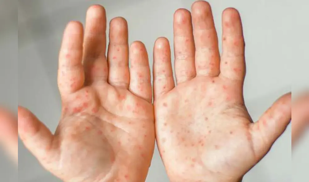 Se identificaron casos en las provincias de Piura, Sullana y Talara. Foto: Andina Se identificaron casos en las provincias de Piura, Sullana y Talara. Foto: Andina