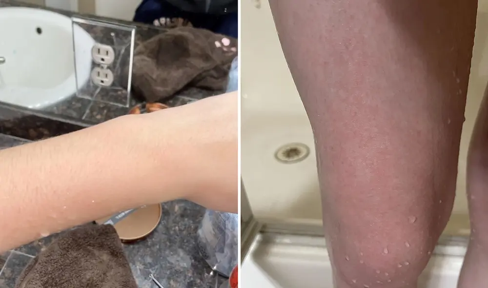 Algunas de las reacciones que provoca esta condición son salpullido, mareos, cansancio, malestar abdominal y dolor en el pecho. Foto: Composición LR / Kennedy News