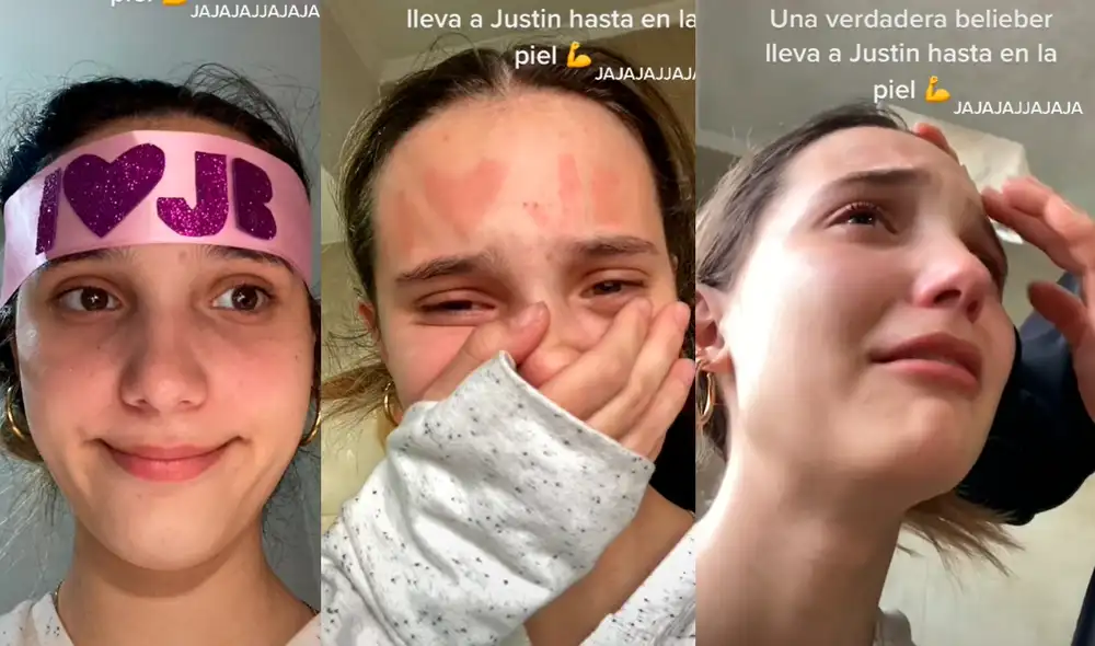 La joven tuvo que aplicarse cremas en la frente para sanar la reacción alérgica. Foto: captura de TikTok La joven tuvo que aplicarse cremas en la frente para sanar la reacción alérgica. Foto: captura de TikTok