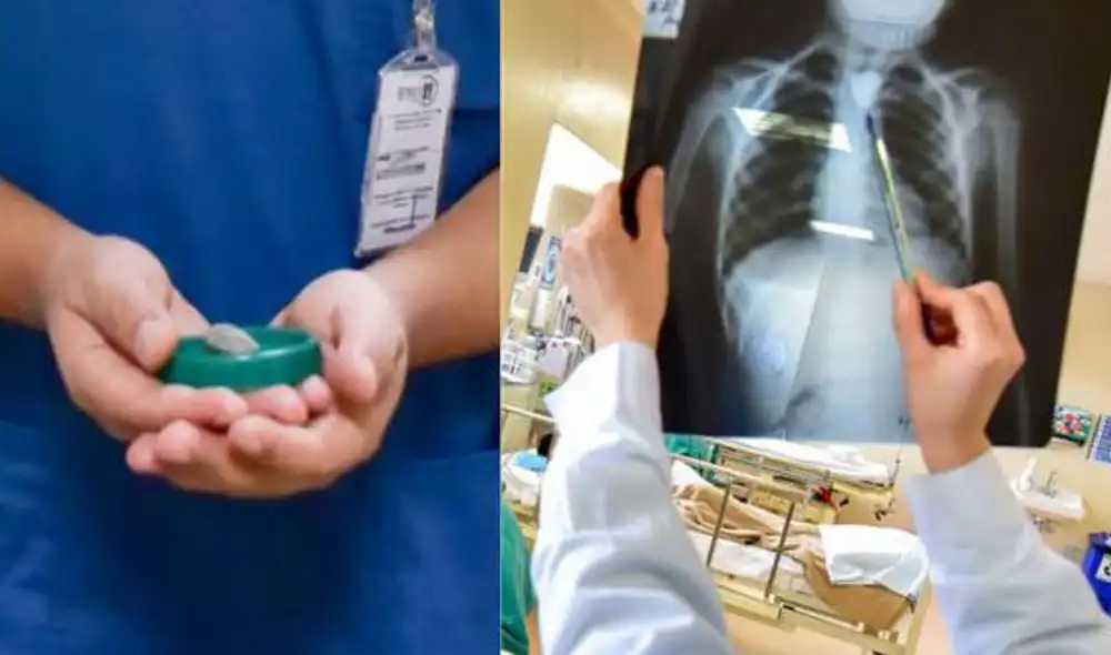 Realizaron al menor un procedimiento especializado de casi 1 hora de duración para extraer la piedra de 2.5x2x1cm. Foto: INSN San Borja. Realizaron al menor un procedimiento especializado de casi 1 hora de duración para extraer la piedra de 2.5x2x1cm. Foto: INSN San Borja.