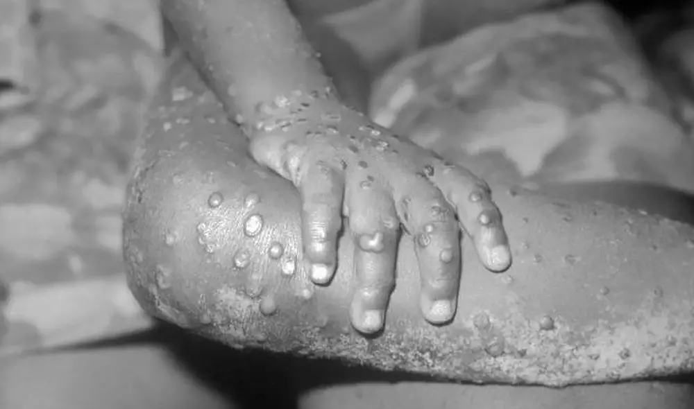 Erupción de la viruela del simio. Foto: Public Health Image Library of the Centers for Disease Control and Prevention