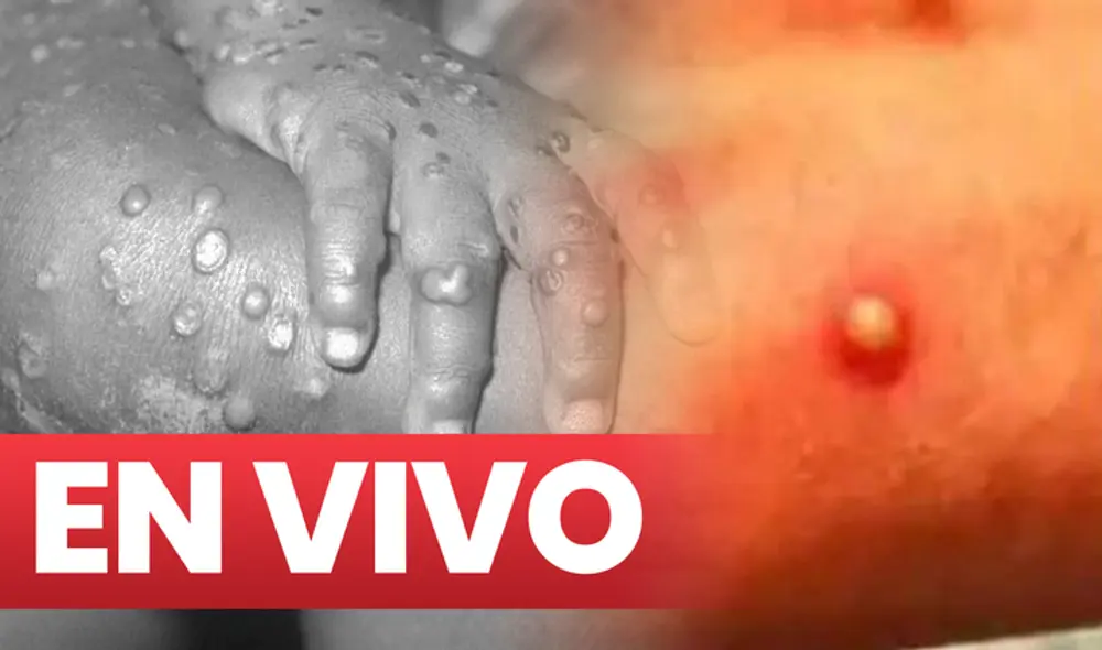 Viruela del mono: últimas noticias sobre el virus que se ha reportado en Europa y Estados Unidos. Foto: composición/difusión