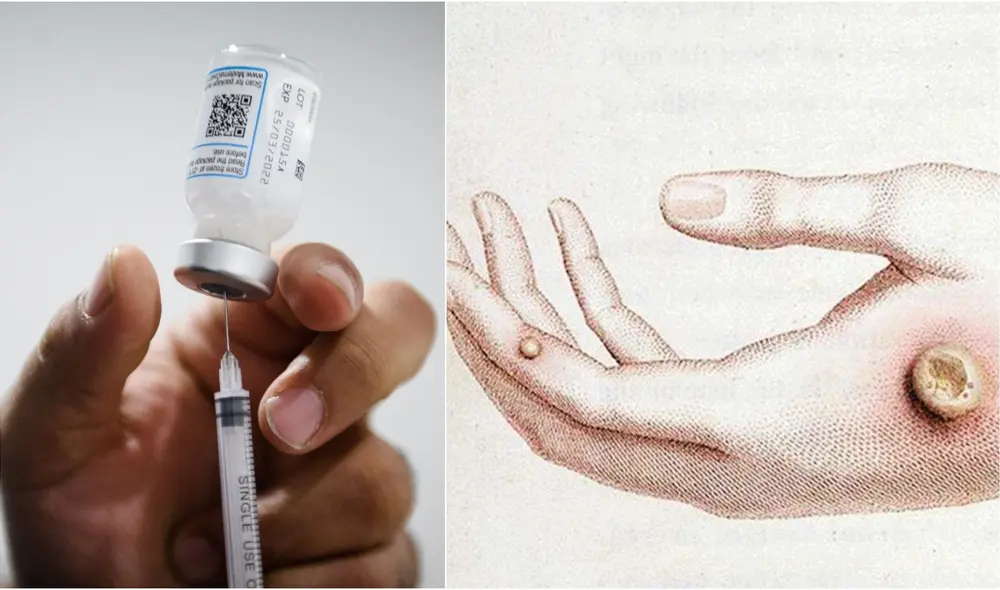 Como la viruela del mono no es nueva, ya se tiene una vacuna específica para prevenirla. Foto: composición LR / AFP / difusión