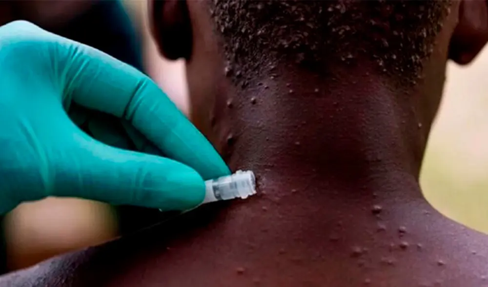 Estados Unidos, Canadá y varios países de Europa ya han confirmado sus primeros casos de viruela del mono. Foto: ABC Estados Unidos, Canadá y varios países de Europa ya han confirmado sus primeros casos de viruela del mono. Foto: ABC