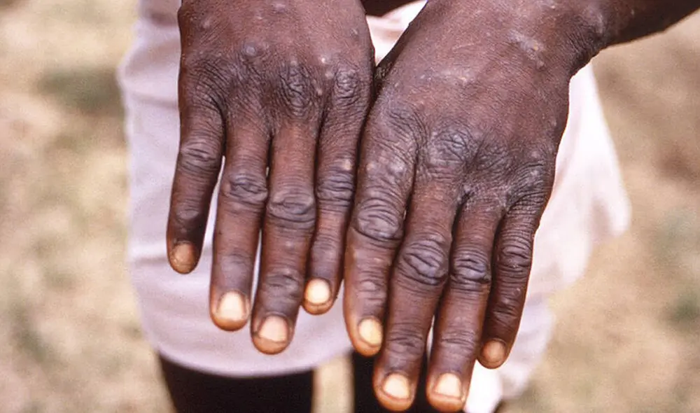 Varios países reportaron la presencia de la viruela del mono. Foto: CDC