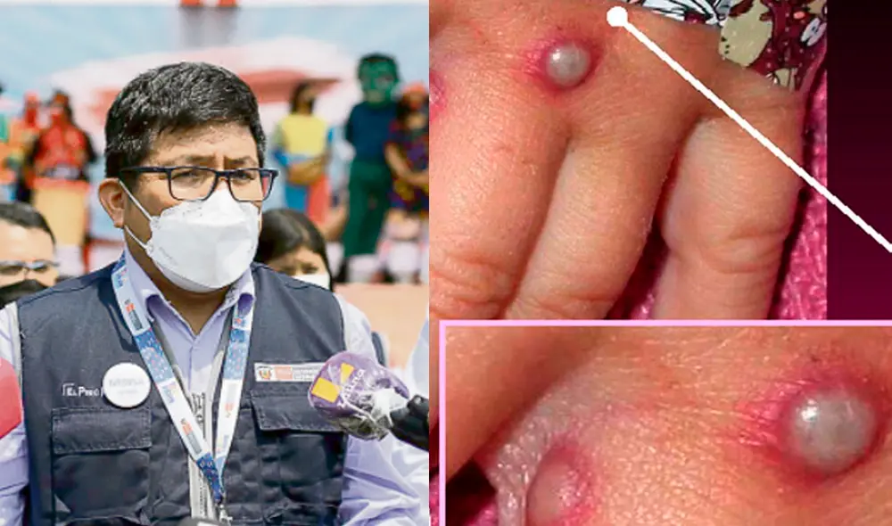 El Minsa indicó que la alerta por la viruela del mono se dará a modo de prevención. Foto: LR