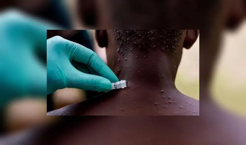 El primer caso de la viruela de mono se reportó en la República Democrática del Congo en 1970. Foto: Nigeria Centre for Disease Control. El primer caso de la viruela de mono se reportó en la República Democrática del Congo en 1970. Foto: Nigeria Centre for Disease Control.