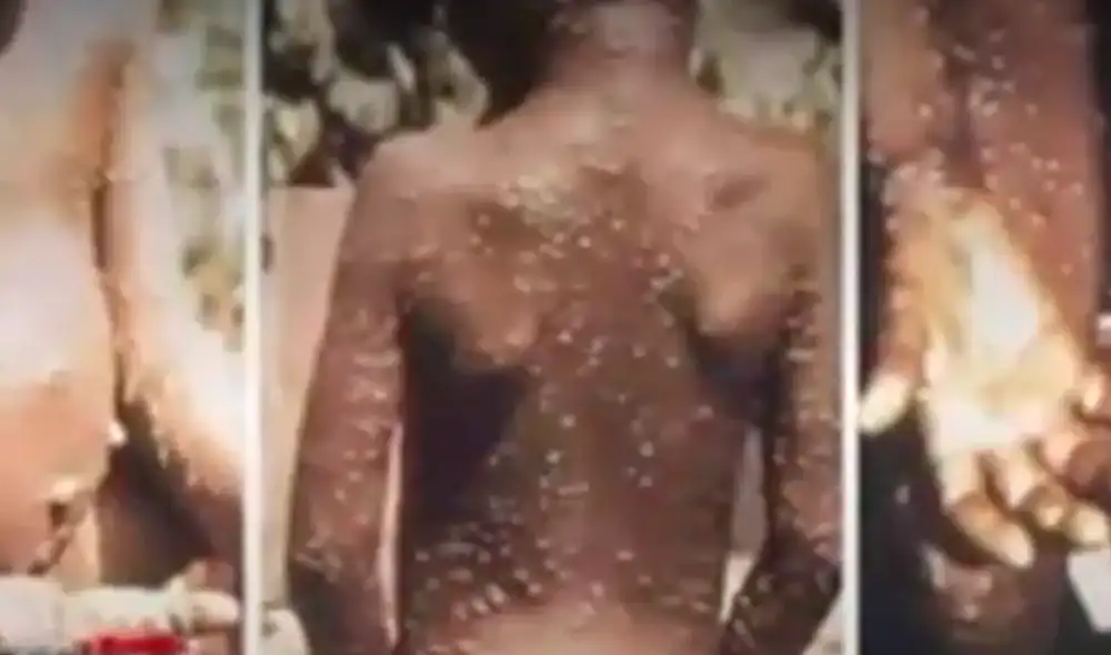 Las edades de los casos registrados de la viruela del mono varían entre los 20 y 40 años. Video: ATV