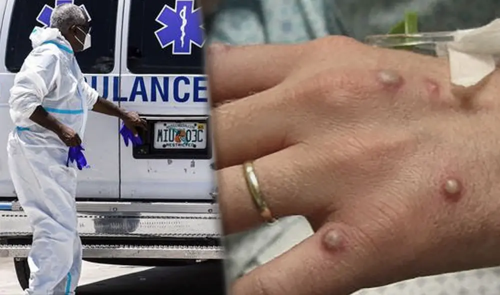 El primer caso se registró en 1970 en la República Democrática del Congo. Foto composición: Breaking911/ Twitter / AFP El primer caso se registró en 1970 en la República Democrática del Congo. Foto composición: Breaking911/ Twitter / AFP