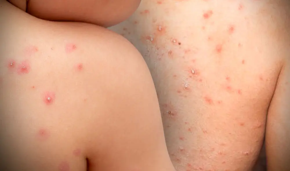 Las autoridades sanitarias de Norteamérica y Europa han detectado decenas de casos sospechosos o confirmados de viruela del mono durante la última semana. Foto: composición/difusión