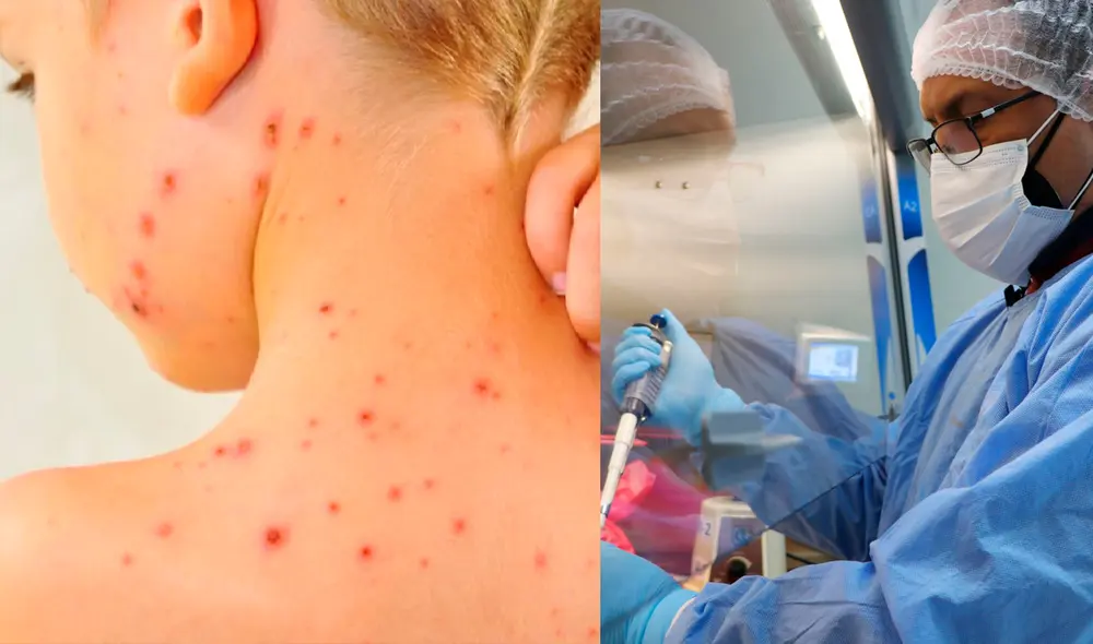 La viruela del mono fue descubierta en 1958 en grupos de simios que eran usados en investigaciones clínicas. Foto: composición/ Andina