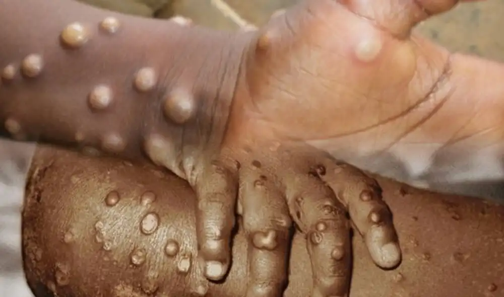 Enfermedad desapareció en 1980 gracias a las vacunas contra la viruela. Foto: composición La República