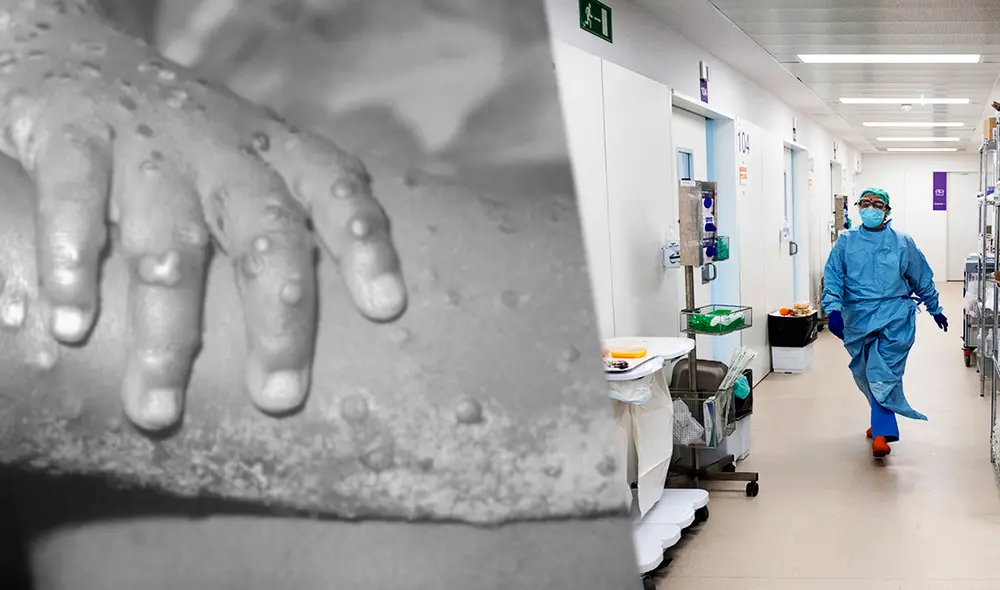 El último 7 de mayo, equipos médicos confirmaron el primer caso de viruela del mono en Reino Unido. Foto:  Public Health Image Library of the Centers for Disease Control and Prevention/AFP/Univisión