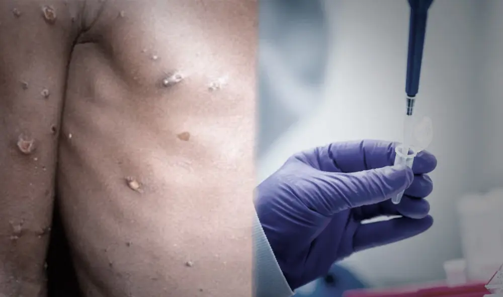 Hubo un brote de viruela del mono en 2003 que logró ser erradicado. Foto: composición/ La Vanguardia/ Bavarian Nordic