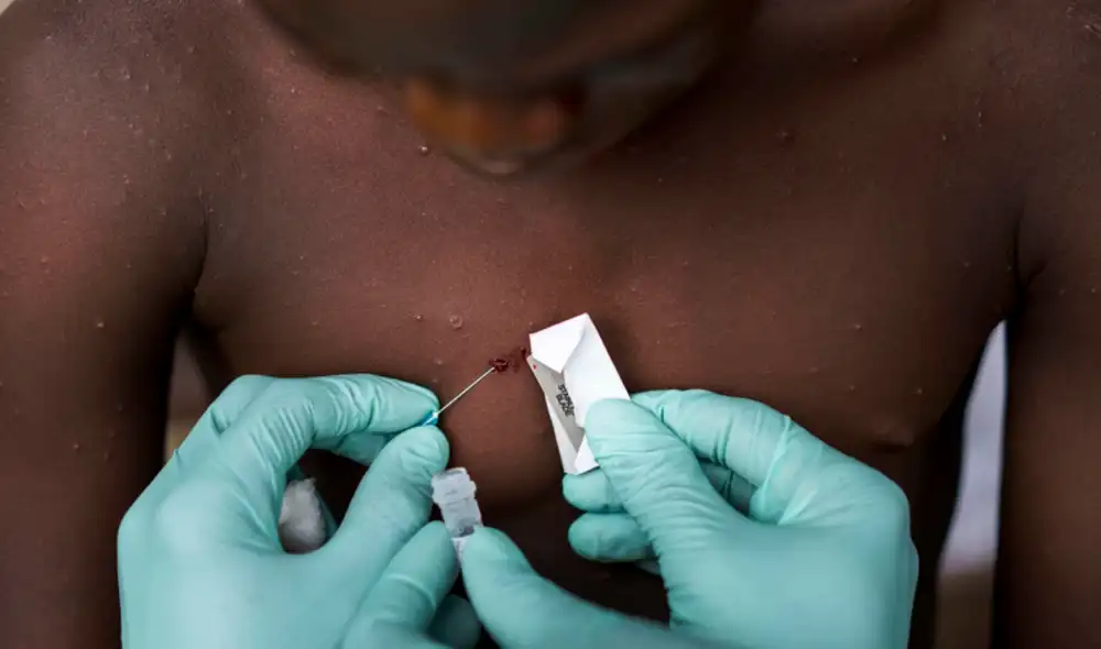 Diversos países de distintos continentes han reportado casos de viruela del mono (monkeypox). Foto: Melina Mara / The Washington Post