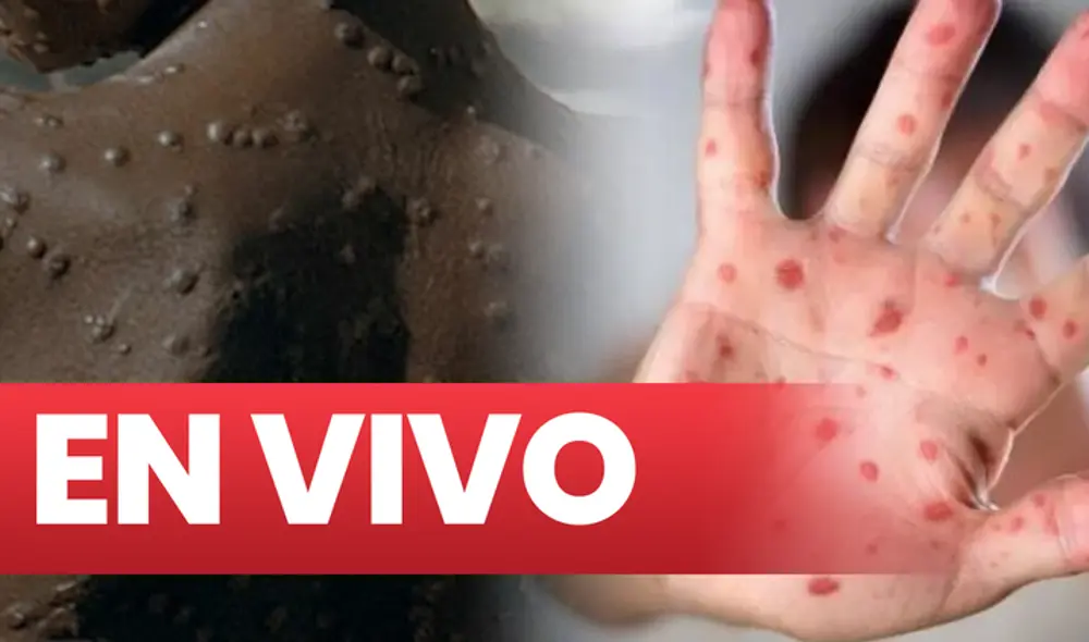 La Agencia Europea del Medicamento (EMA) está analizando posibles tratamientos y vacunas disponibles contra la viruela del mono en la actualidad. Foto: composición/difusión La Agencia Europea del Medicamento (EMA) está analizando posibles tratamientos y vacunas disponibles contra la viruela del mono en la actualidad. Foto: composición/difusión