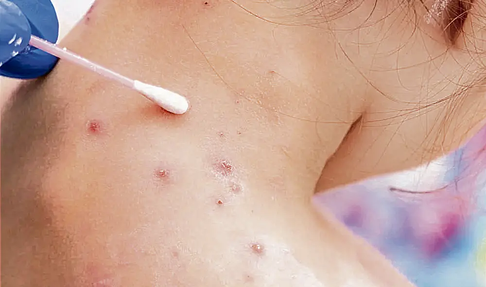 Síntoma. La aparición de erupciones en la piel es la característica principal de la enfermedad.