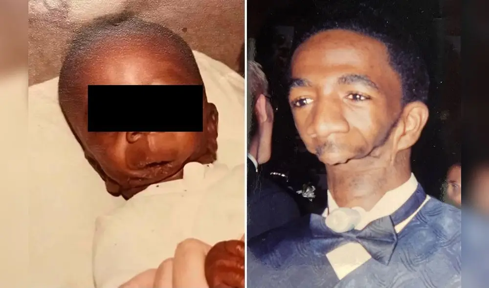 “Nacer sin mandíbula fue un shock para mi madre biológica”, dijo Williams. Foto: CATERS “Nacer sin mandíbula fue un shock para mi madre biológica”, dijo Williams. Foto: CATERS