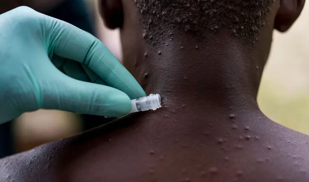 Personal de salud extrae muestra de lesión cutánea en un joven sospechoso de estar infectado con la viruela del mono. Foto: The Washington Post