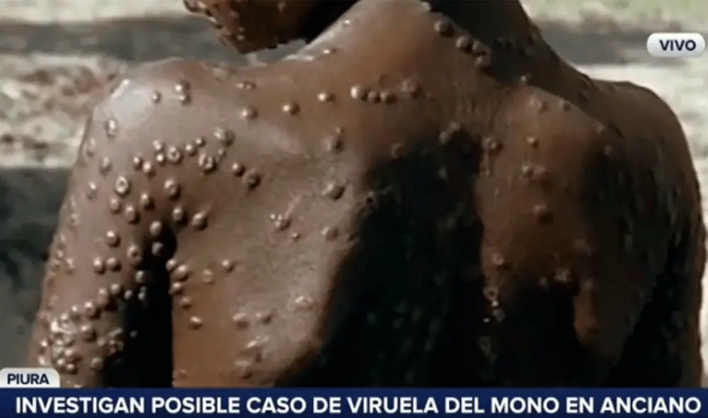 El director del hospital Santa Rosa de Piura descartó que el paciente haya sido estigmaitizado como habían denunciado sus familiares previamente. Video: RPP El director del hospital Santa Rosa de Piura descartó que el paciente haya sido estigmaitizado como habían denunciado sus familiares previamente. Video: RPP