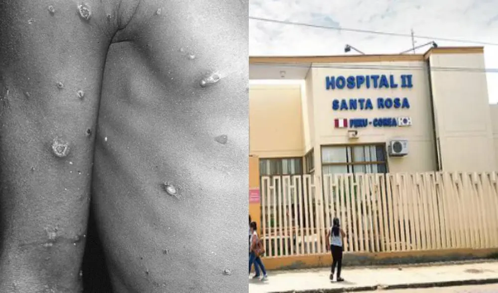 En alerta. El paciente sospechoso con viruela del mono habría contraído el virus fuera del territorio peruano. Foto: composición LR-EFE.