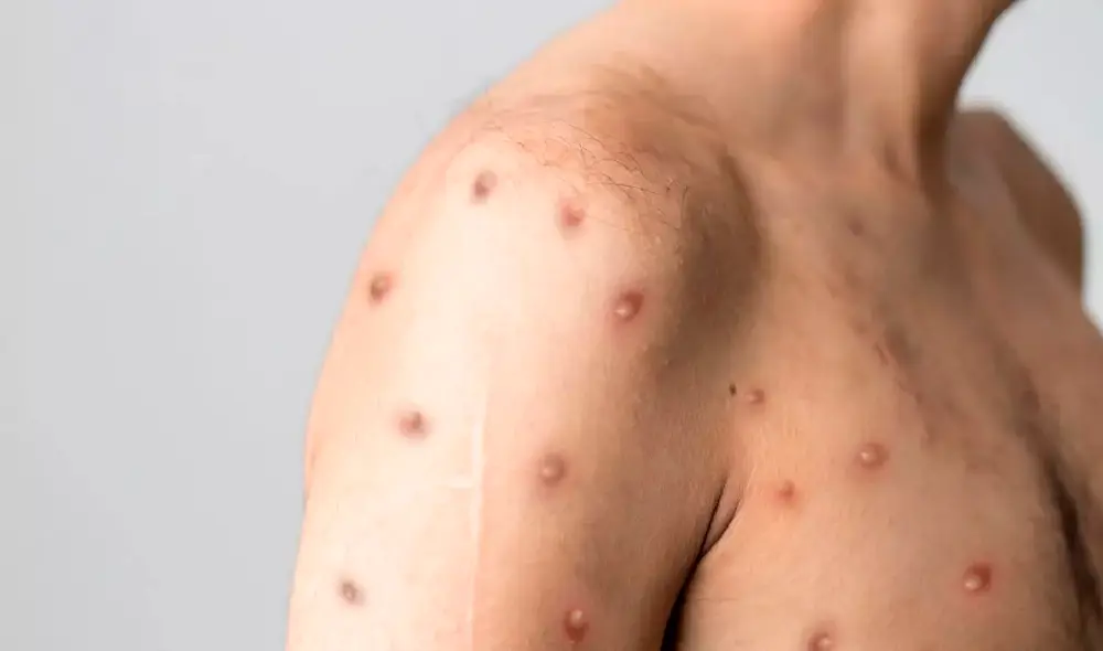 El brote de la viruela del mono es “poco probable” que se convierta en una pandemia, dice la OMS. Foto: Shutterstock/Berkay Ataseven