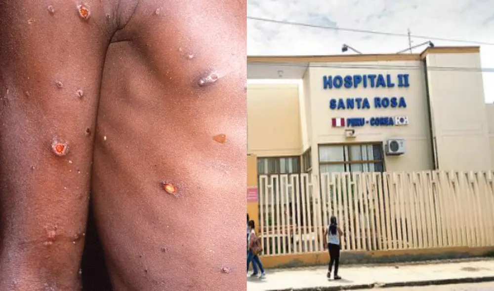 En alerta. El paciente sospechoso con viruela del mono habría contraído el virus fuera del territorio peruano. Foto: composición LR-EFE.