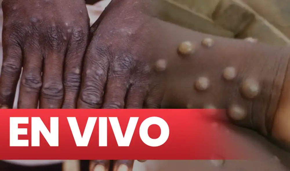 El brote de la viruela del mono es “poco probable” que se convierta en una pandemia como la de COVID-19, dice la OMS. Foto: composición/difusión