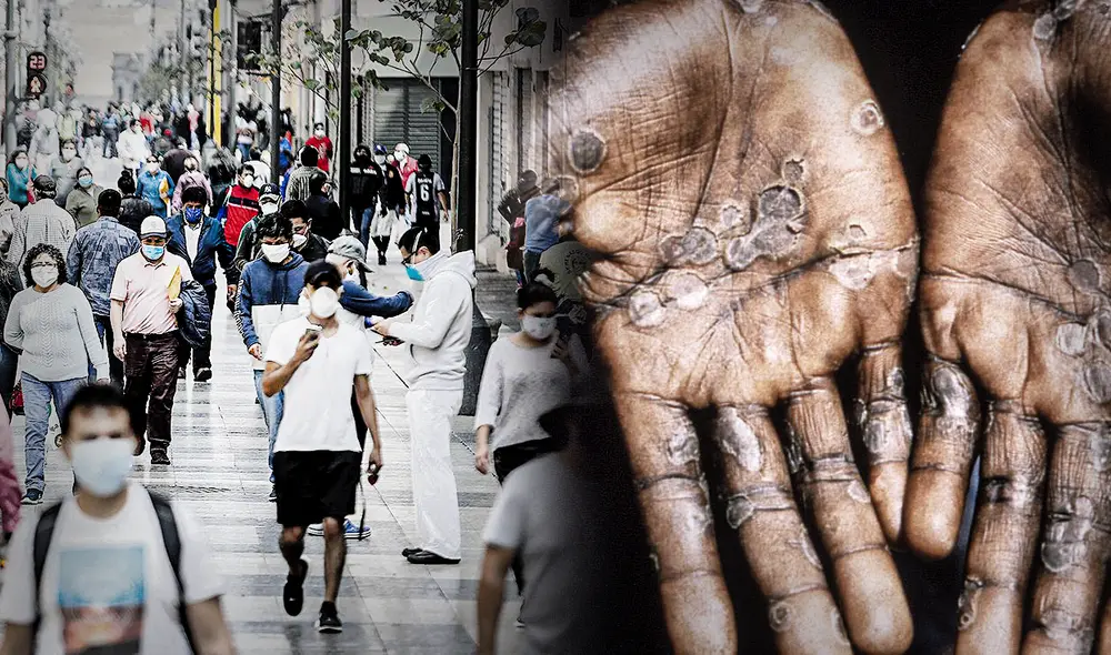 Viruela del mono. Foto: composición de Jazmin Ceras. Viruela del mono. Foto: composición de Jazmin Ceras.