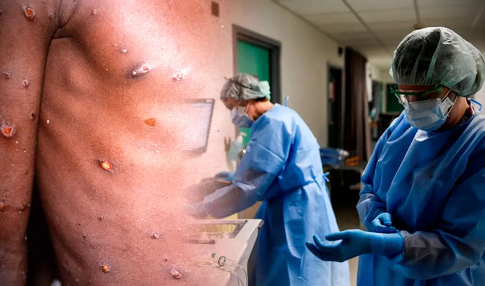 Pese a los casos confirmados en Europa, la EMA  subrayó que el mundo no está en “una emergencia de salud pública” por la viruela del mono. Foto: composición/EFE/AFP