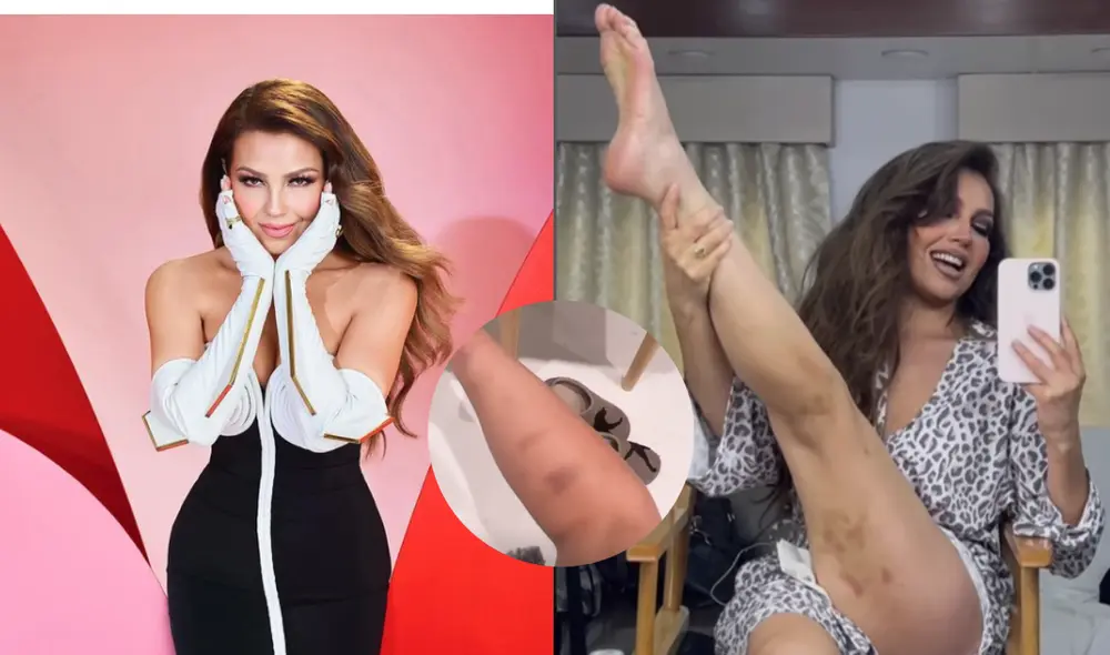 Thalía preocupó a sus seguidores por tener lesiones en las piernas. Foto: Instagram. Thalía preocupó a sus seguidores por tener lesiones en las piernas. Foto: Instagram.