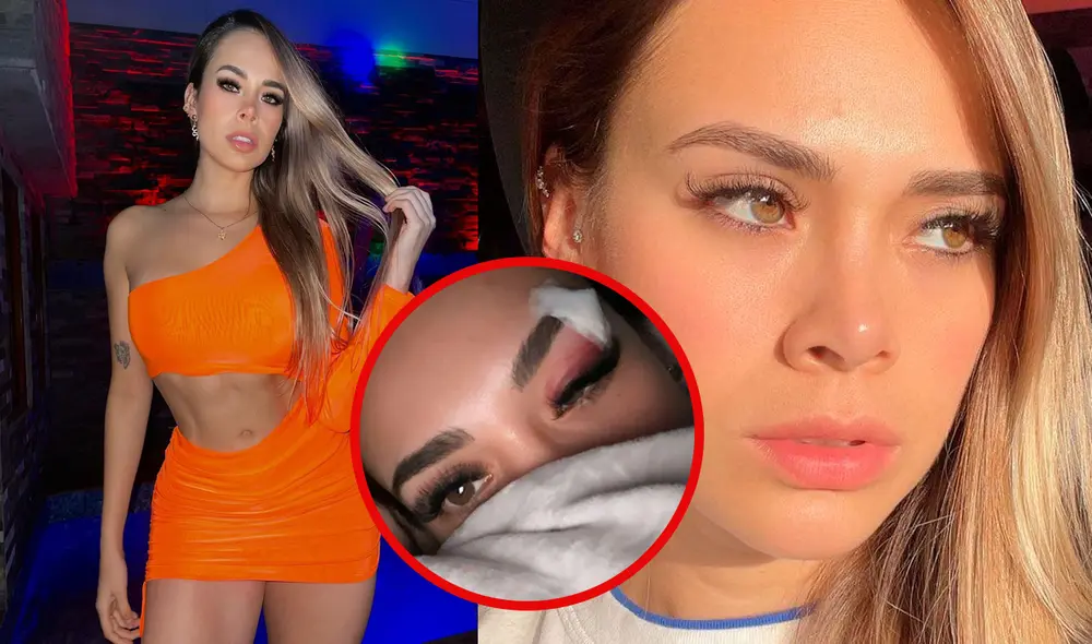 Jossmery Toledo casi pierde ojo por sensible accidente con una botella de champagne.