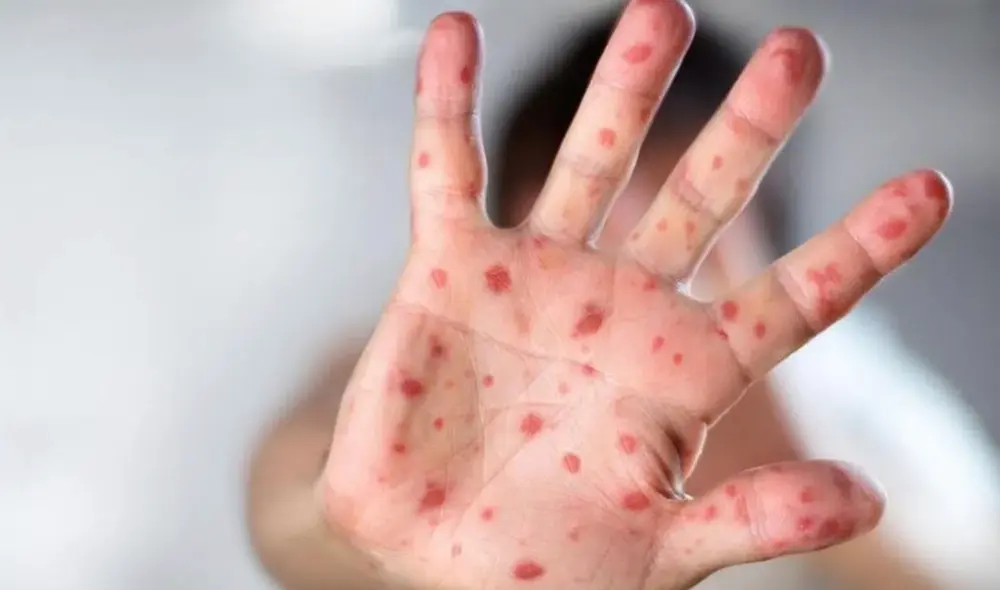 Conoce los detalles del primer caso de viruela de mono en Perú. Foto: Archivo LR