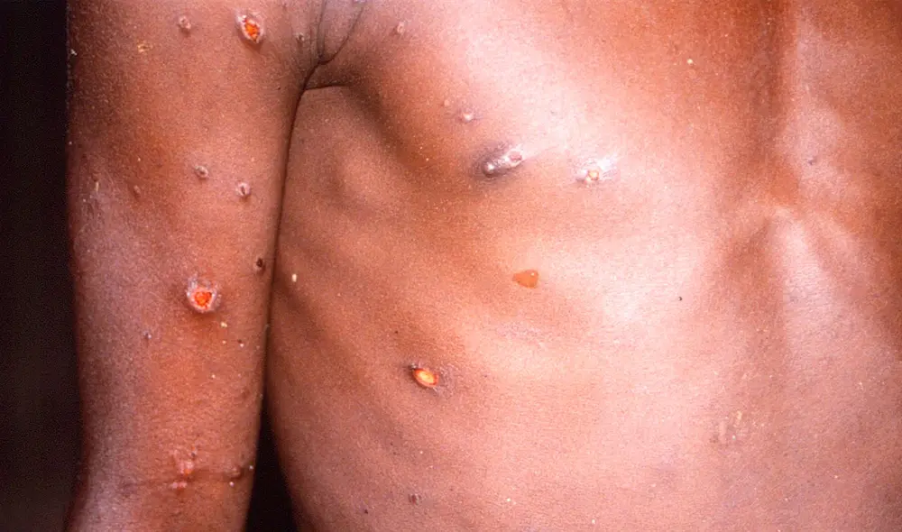 Este domingo 26 de junio, el ministro de salud del Perú informó sobre el primer caso confirmado de monkeypox. Foto: EFE Este domingo 26 de junio, el ministro de salud del Perú informó sobre el primer caso confirmado de monkeypox. Foto: EFE