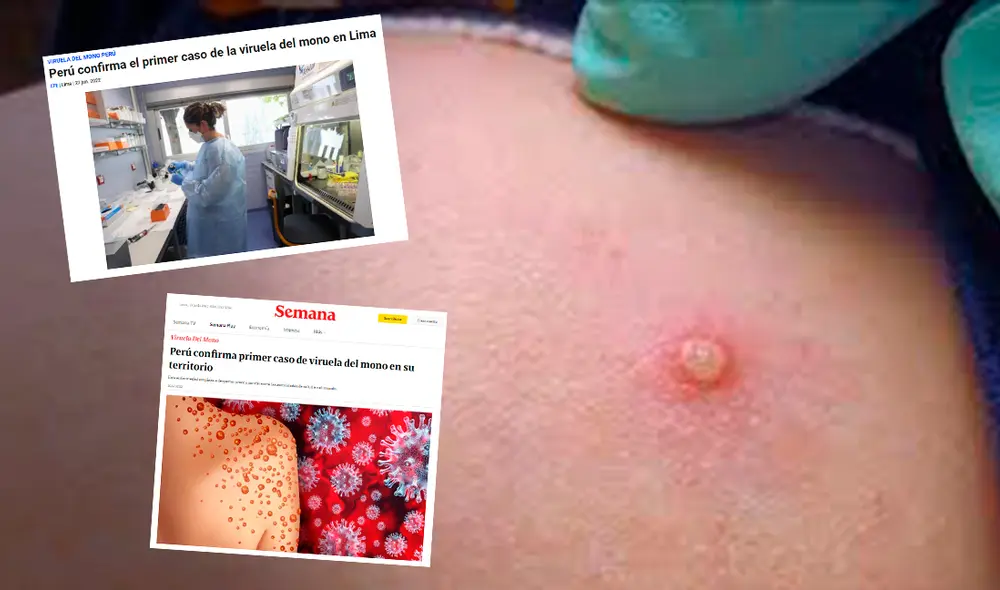Diversos medios internacionales de la región y el mundo informaron sobre el primer caso de viruela del mono en Perú. Foto: CNN/ Composición GLR Diversos medios internacionales de la región y el mundo informaron sobre el primer caso de viruela del mono en Perú. Foto: CNN/ Composición GLR