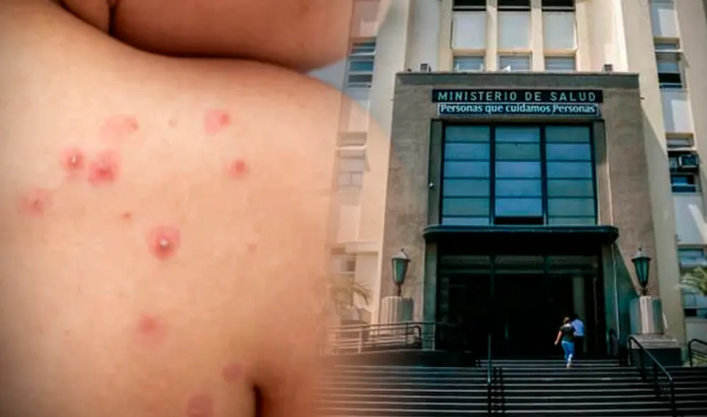 La principal característica de la Viruela del Mono son las erupciones de la piel. Composición LR AS España/Gobierno del Perú