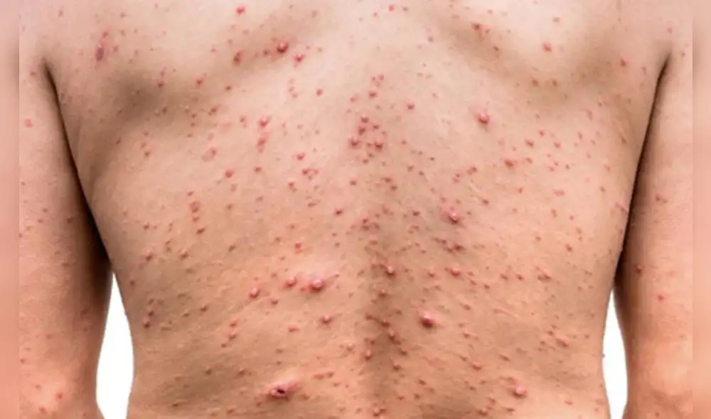 En la segunda fase de la erupción cutánea, comienzan a surgir ampollas y bultos en la piel. FOTO: Infobae