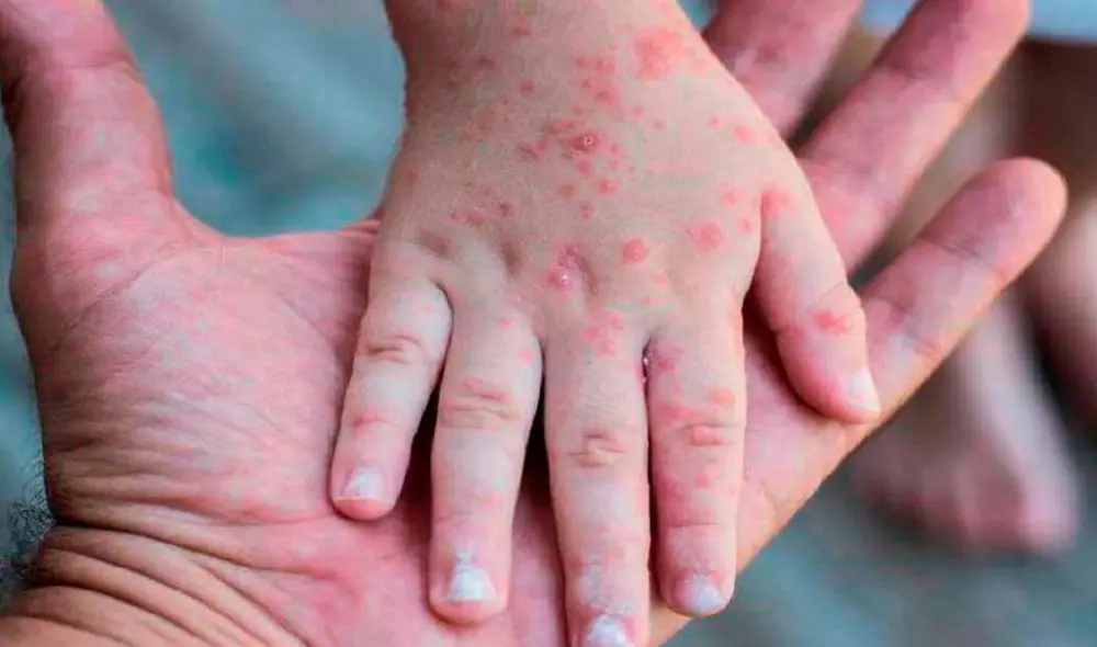 La enfermedad ataca principalmente a niños y personas inmunodeprimidas. FOTO: EFE